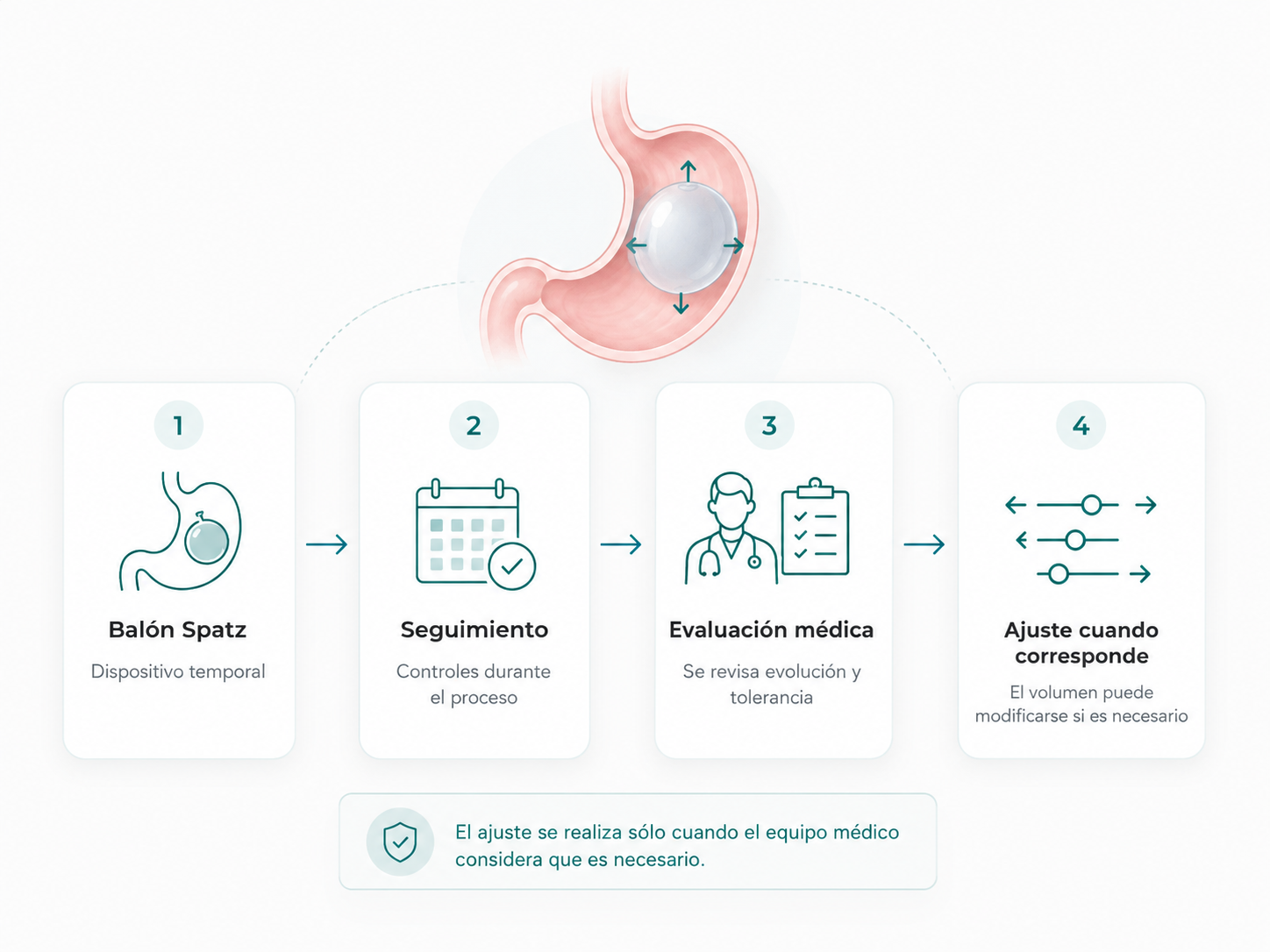Infografía del ajuste del balón Spatz: balón temporal, seguimiento con controles, evaluación médica y ajuste de volumen cuando el equipo médico lo considera necesario